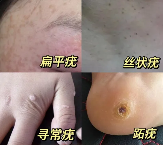 健康无“疣” | 皮肤疣知多少？及时治疗是关键