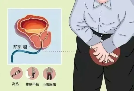 前列腺钙化灶：了解它，不必过度担忧