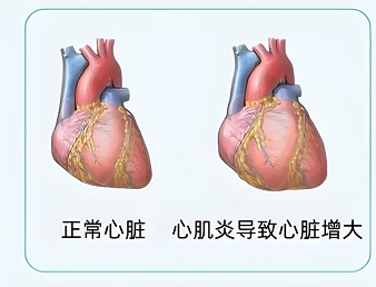 感冒后胸闷乏力？警惕心肌炎这个“隐形杀手”