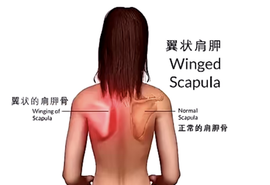 摆脱“天使之翼”，重塑健康肩膀—翼状肩胛的康复指南！